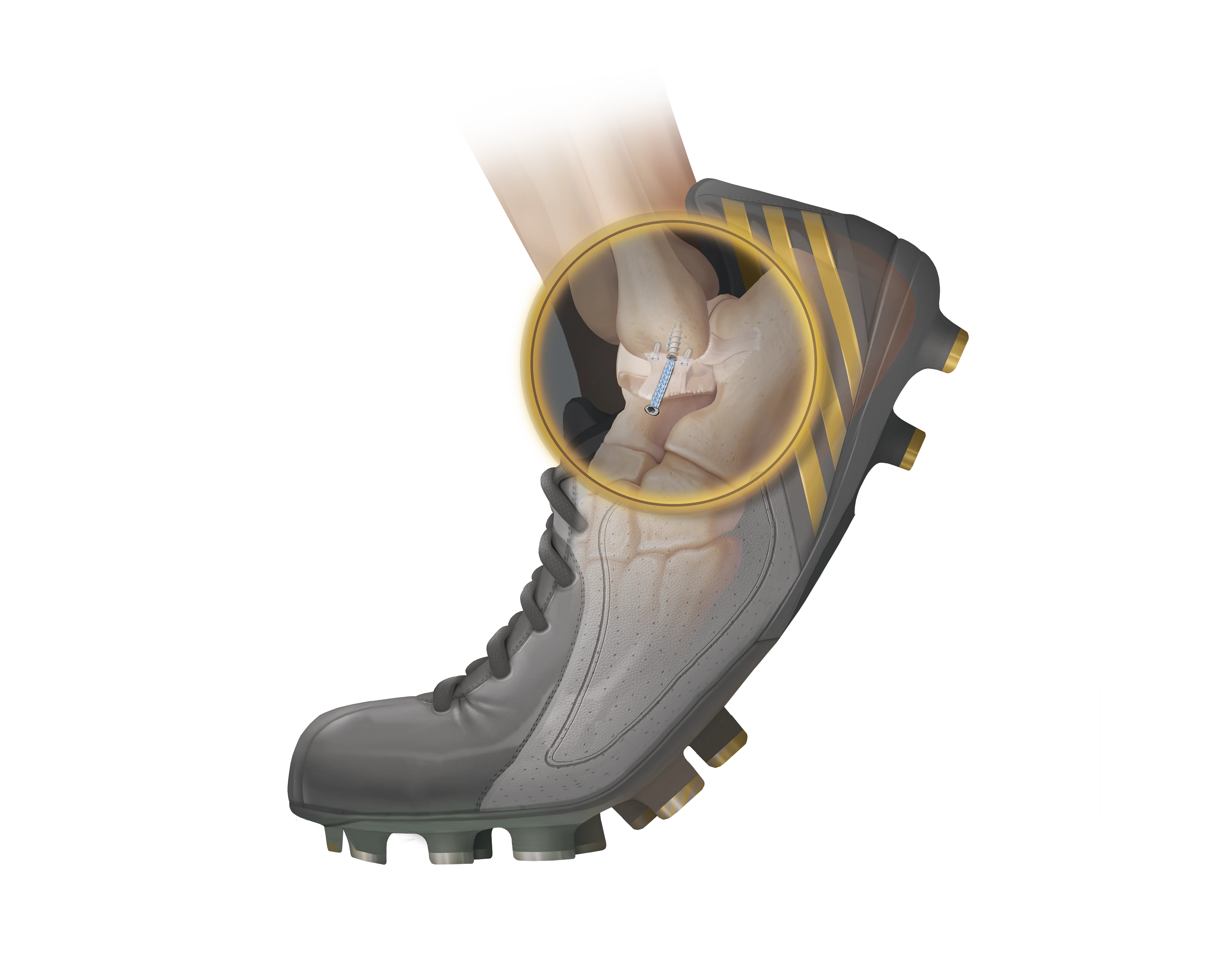 Arthrex InternalBrace Ankle Ligament Augmentation