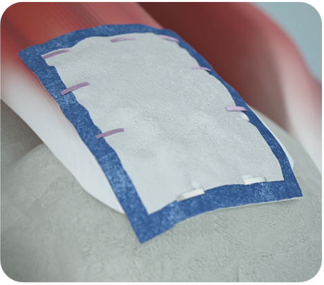 REGENETEN Bioinductive Implant