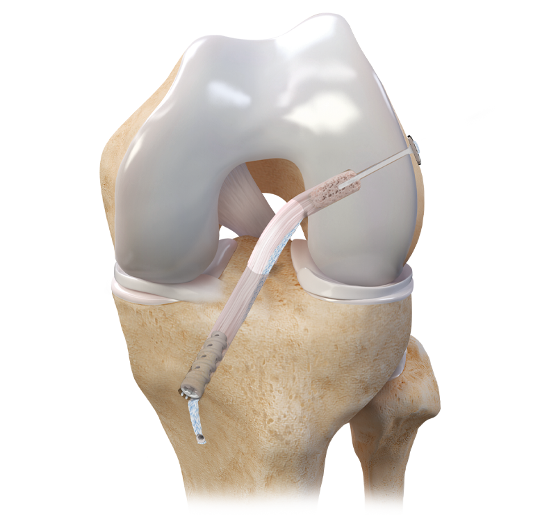 ULTRABUTTON QUAD Fixation