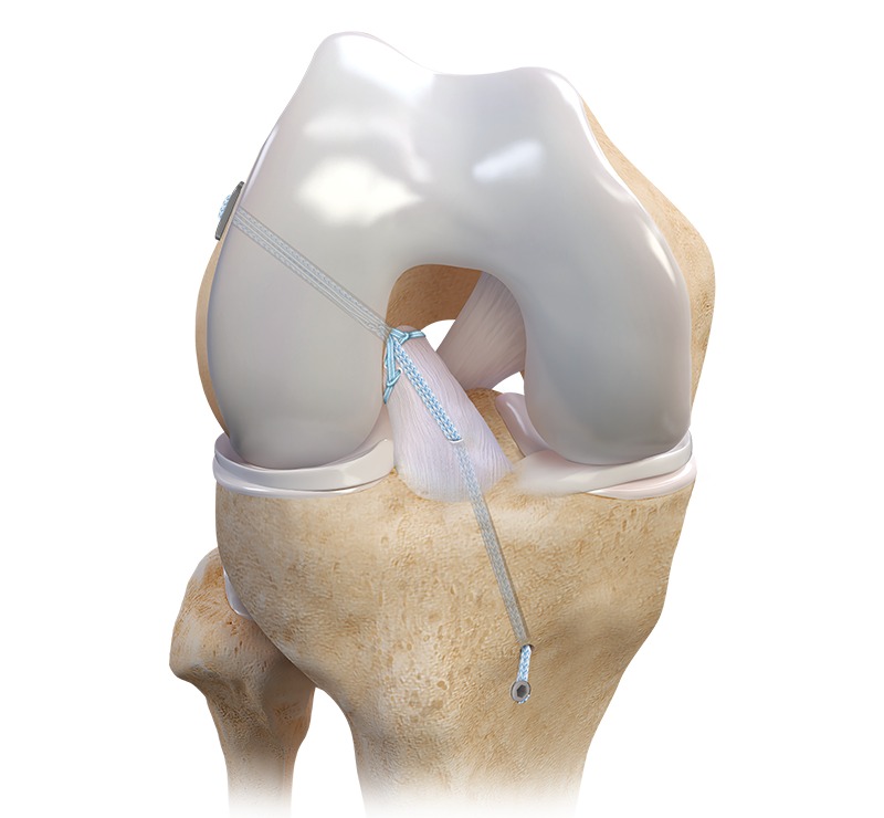 ACL Repair with SwiveLock Illustration