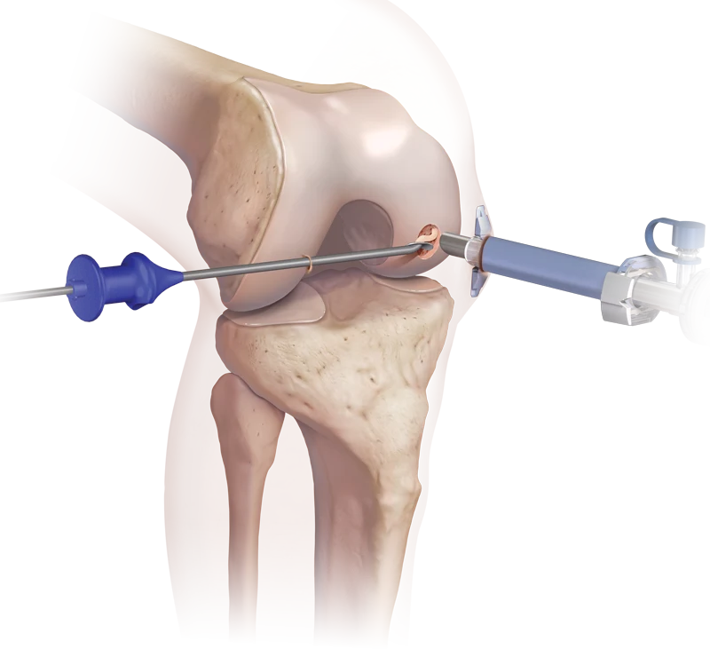 Arthrex BioCartilage Biological Scaffold